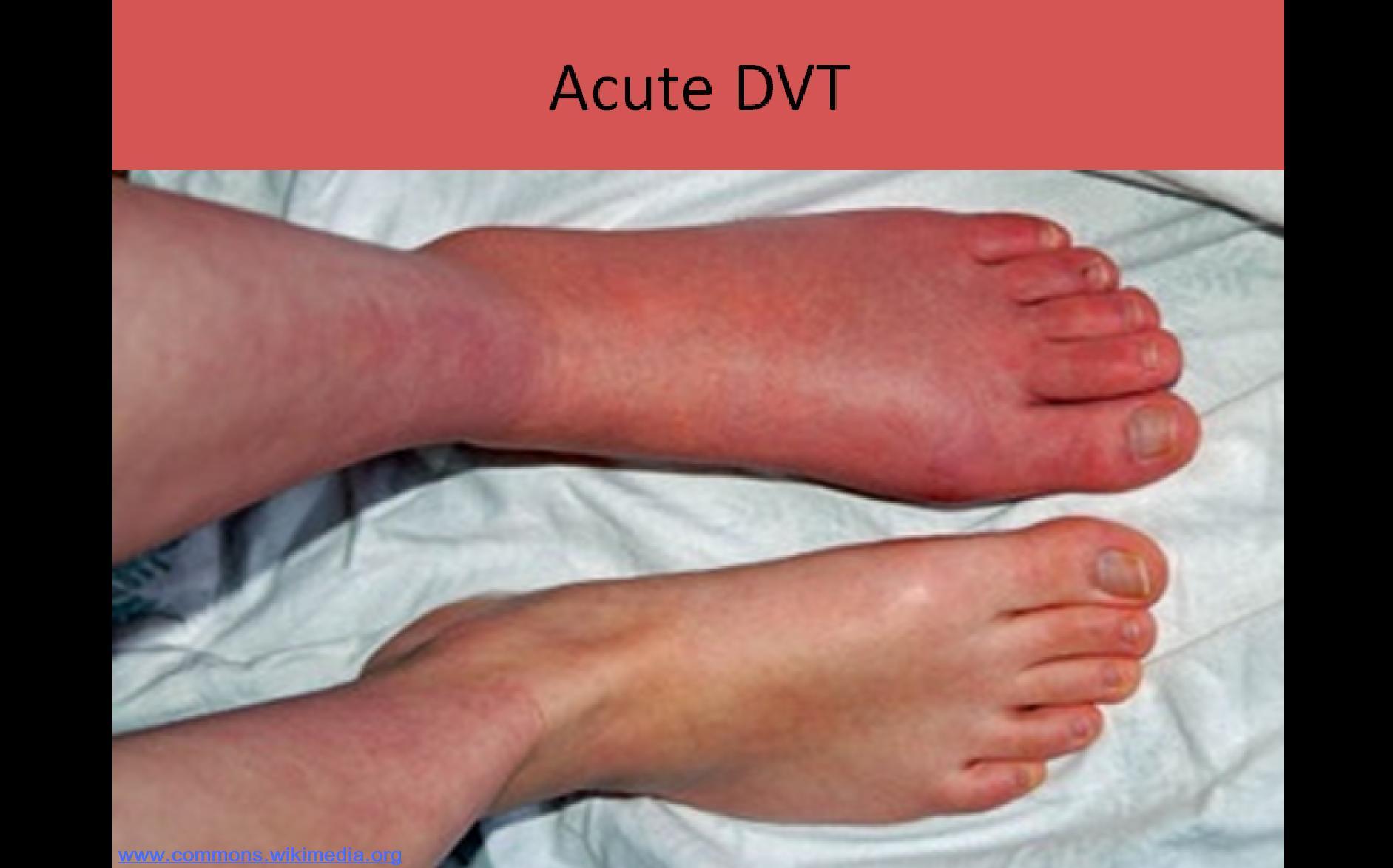 dvt
