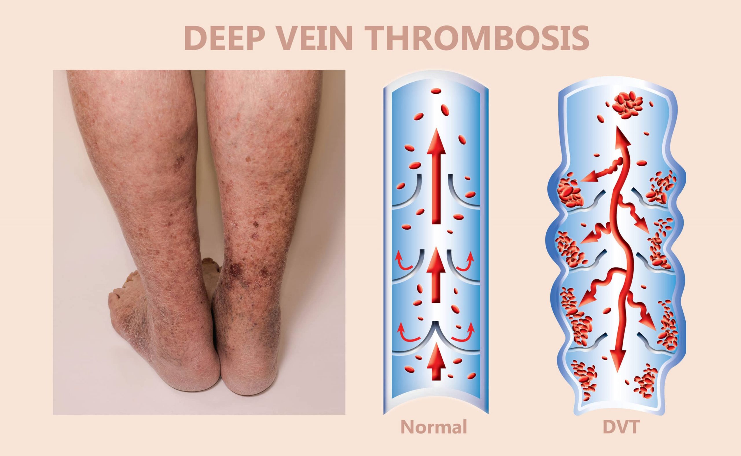 dvt