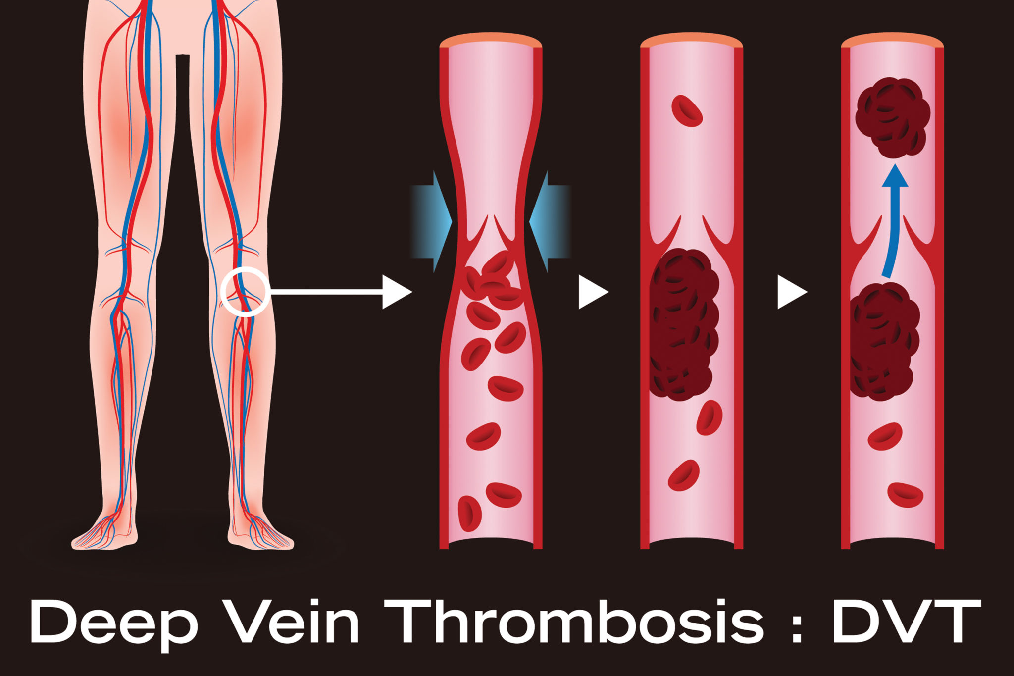 dvt